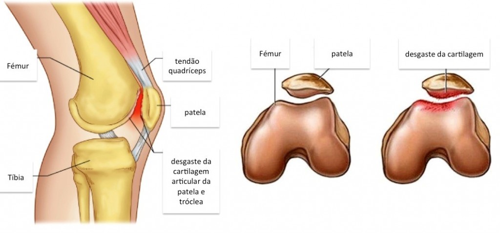 Condropatia Patelar Meu Joelho