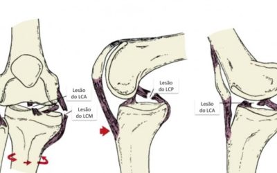 Lesão multiligamentar no joelho