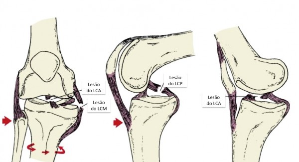 Lesão multiligamentar no joelho