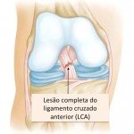 Lesão do Ligamento Cruzado Anterior (LCA)
