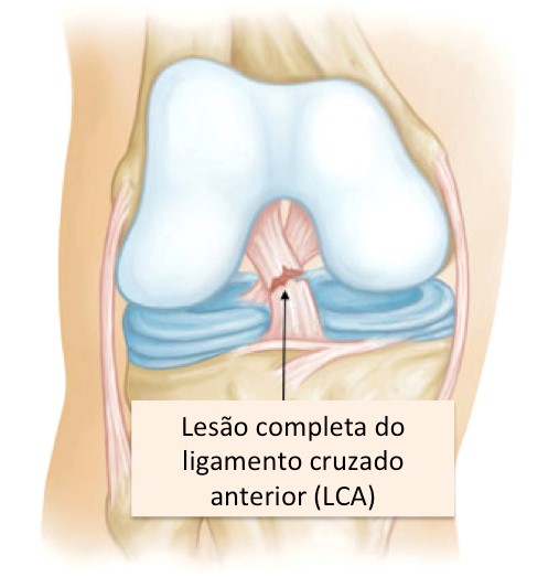 Lesão do Ligamento Cruzado Anterior (LCA)