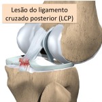 Lesão do Ligamento Cruzado Posterior (LCP)