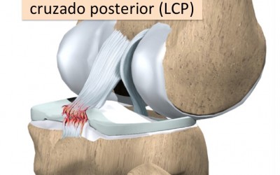Lesão do Ligamento Cruzado Posterior (LCP)