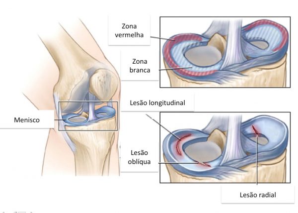 Lesão Meniscal